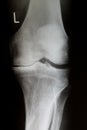 X-Ray image of knee joint with advanced arthrosis Gonarthrose