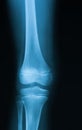 X-ray image of knee joint. Royalty Free Stock Photo