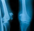 X-ray image of knee joint, AP and lateral view.