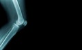 X-ray image knee joint with banner design Royalty Free Stock Photo