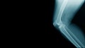 x-ray image knee joint with banner Royalty Free Stock Photo