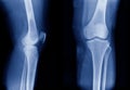 X-ray image of knee joint show mild degenerative change