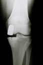 X-Ray image of knee with medial artificial partial prosthesis Endoprosthesis in case of arthrosis joint degeneration Royalty Free Stock Photo