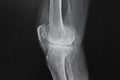 X ray image of knee. X-ray of the knee joint