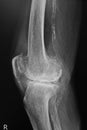 X ray image of knee. X-ray of the knee joint