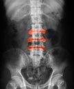 X-ray image of L-S spine, AP view.