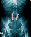 X-ray image l-spine fixation