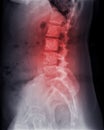 X-ray image of lambosacral spine or L-S spine showing Bone metastasis