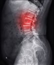 X-ray image of lambosacral spine or L-S spine showing lesion at L3