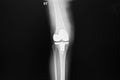 Right knee joint with total knee replacement.