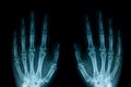 X-ray image of left and right human hands Royalty Free Stock Photo