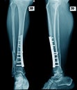 Distal tibia fracture and distal fibular fusion Royalty Free Stock Photo