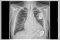 X-ray image, links, artificial heart pacemaker Royalty Free Stock Photo