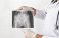 X-ray image of LS spine, AP view, show ankylosing spondylitis lumbar,Doctor examining a lung radiography, Doctor looking chest x-r Royalty Free Stock Photo