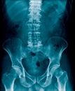 X-ray image lumbar bone