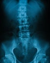 X-ray image of lumbar spine, AP view.