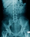 X-ray image lumbar spine and degenerative change of spine