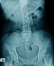 X-ray image lumbar spine and degenerative change of spine