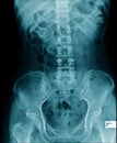 X-ray image lumbar spine and degenerative change of spine