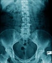 X-ray image lumbar spine and degenerative change of spine