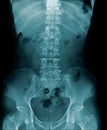 X-ray image lumbar spine and degenerative change of spine