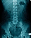 X-ray image lumbar spine and degenerative change of spine