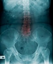 X-ray image lumbar spine and degenerative change of spine