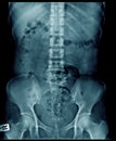 X-ray image lumbar spine