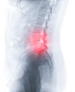 X-ray image of lumbar Spine  or L-s spine lateral view for diagnosis lower back pain Royalty Free Stock Photo