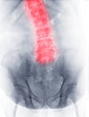 X-ray image of lumbar Spine or L-s spine Front view showing scoliosis
