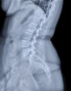 X-ray image of lumbar Spine  or L-s spine lateral view for diagnosis lower back pain Royalty Free Stock Photo
