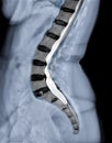 X-ray image of lumbar Spine or L-s spine lateral view with MRI l-s spine for diagnosis lower back pain