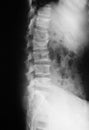 X-ray image of lumbar spine(L-spine), lateral view. showing com Royalty Free Stock Photo