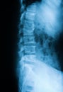 X-ray image of lumbar spine(L-spine), lateral view. showing com Royalty Free Stock Photo