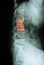 X-ray image of lumbar spine(L-spine), lateral view. Royalty Free Stock Photo