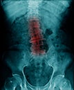 X-ray image lumbar spine