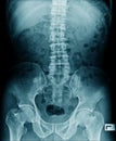 X-ray image lumbar Royalty Free Stock Photo