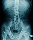 X-ray image lumbar