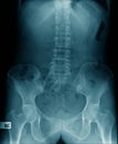 X-ray image lumbar