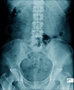 X-ray image lumbar