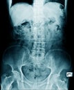 X-ray image of lumbo sacral