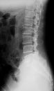 X-ray image of Lumbosacral (L-S) spine. Royalty Free Stock Photo