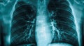 X-ray image of the lung with consolidation and pleural effusion