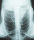 X-ray image of a lung Royalty Free Stock Photo