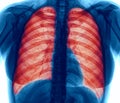 X-Ray Image of Lung infection. Royalty Free Stock Photo