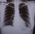 X-ray image of lungs