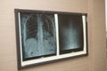 X-ray image of the lungs, the picture is hanging on a medical negatoscope