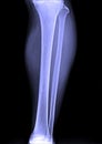 X-Ray image of male human lower leg Royalty Free Stock Photo