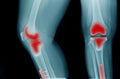 X-ray image of OA knee with banner design Royalty Free Stock Photo