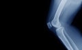 X-ray image of OA knee Royalty Free Stock Photo